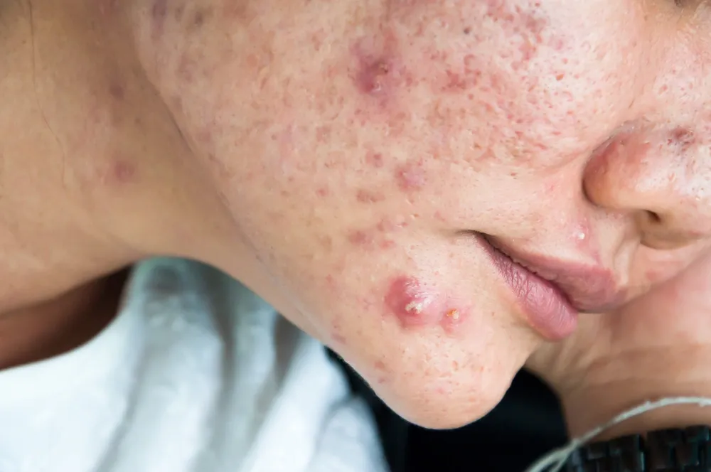 Cystic Acne Treatment Options: From Home Remedies to Prescriptions